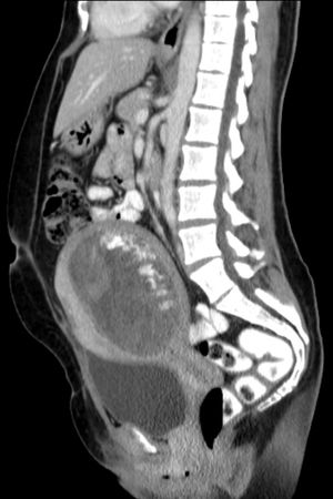 CT 사진, 시상면에서 보이는 포도송이 모양 기태