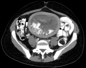 CT 사진, 축면에서 보이는 포도송이 모양 기태