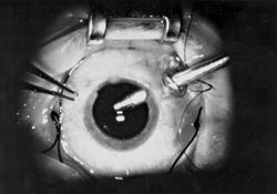 19 게이지 단일 포트 유리체 절제술