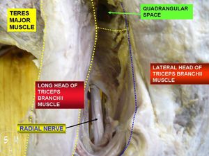 오른쪽 겨드랑이의 요골신경 (뒤쪽 보기)
