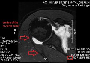 생리학적으로 저신호 강도를 보이는 손상되지 않은 소원근 힘줄.