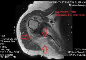 고신호 강도를 보이는 지방 변성 소원근.