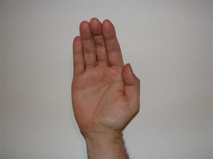 원숭이 손 기형