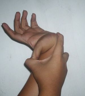 관절 과운동 증후군에서 과신전된 엄지손가락