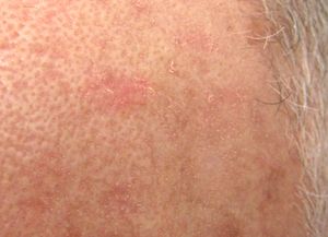 광선 각화증 병변