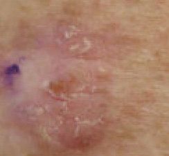 Close up of piece of skin showing pink patches with raised white scales