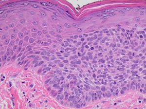 정상 피부(왼쪽)와 광선 각화증(오른쪽)으로, 표피 전체 두께를 포함하지 않는 비정형 기저 각질세포의 특징을 보여준다.
