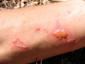 햇볕이 쨍쨍한 날씨에 피부에 나타나는 일반 운향의 영향