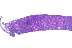 신장 생검에서 발견된 버킷 림프종