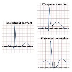  ST 분절 상승 및 하강의 그림