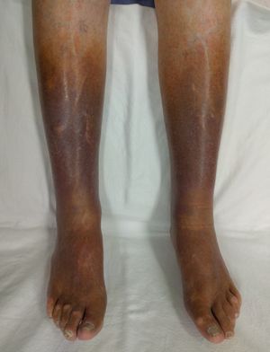 만성 정맥 부전