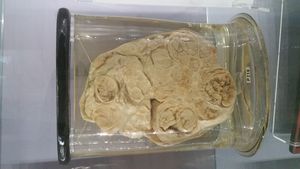 이하선 종양의 표본. 1785년 10월 24일 존 헌터가 존 벌리라는 37세 남성에게서 제거했다. 종양의 무게는 4kg이 넘었고 제거하는 데 25분이 걸렸다. 이 표본은 현재 영국 왕립 외과대학의 헌터리안 박물관에 보관되어 있다.