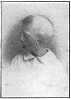 9세 소년의 양측 3단계 소이증