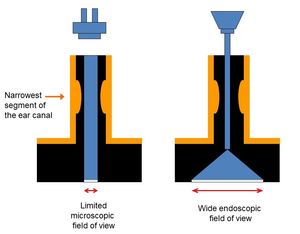 내시경의 넓은 시야는 자연스러운 이도 접근로를 사용하여 진주종을 "코너를 돌아보는" 것을 가능하게 한다.