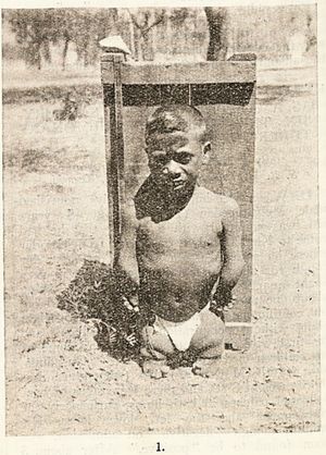 1928년, 양팔과 다리에 해표지증이 있는 9세 인도 소년