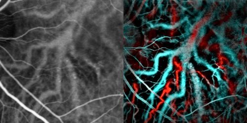 중심장액성망막병증에서 맥락막 혈관을 보여주는 인도시아닌 그린(왼쪽) 혈관조영술과 레이저 도플러 영상(오른쪽). 파란색과 빨간색은 각각 낮은 혈류와 높은 혈류에 해당한다.