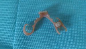 유연한 나일론 레진으로 제작된 가철성 국소 의치