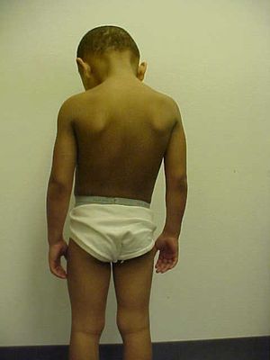 X 연관 어린선 환자의 피부 증상