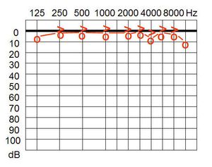 표준화된 정규 분포에서 전형적인 청력 변화를 보여주는 청력도.