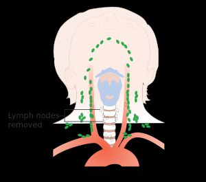 수술 후 갑상선수질암(MTC)으로 중심 림프절과 갑상선을 제거하는 것을 보여주는 그림