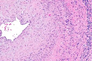 중간 배율 현미경 사진으로, 측두 동맥 생검에서 거대 세포 동맥염을 보여준다. 동맥 내강이 왼쪽에 보인다. 거대 세포는 두꺼워진 내막과 중막 사이의 경계면 오른쪽에 보인다. H&E 염색