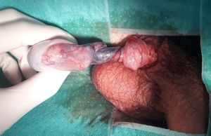 고환 꼬임 이미지