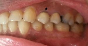 치아-금속 융합 수복물에서 금속이 부자연스럽게 보이는 모습