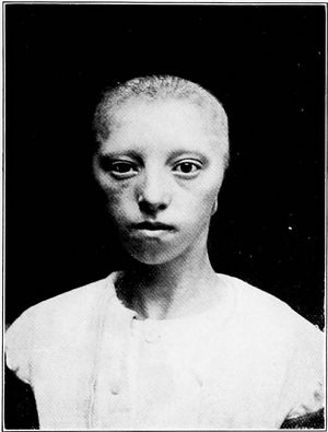 1904년, 10세 소년의 양측성 무이증