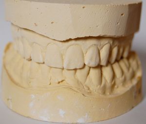 더 비싼 그릴은 이와 같은 맞춤형 치과용 틀에 맞게 제작된다.
