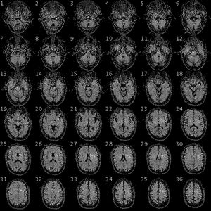 개인 유전체 프로젝트에 참여한 참가자의 뇌 fMRI 이미지