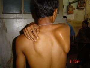 오른쪽 날개어깨뼈