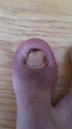 발톱 제거 수술 후