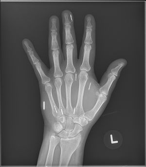 여러 임플란트가 있는 바이오해커의 손 X선 사진