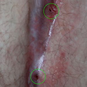 두 개의 모소동 누공(원 안)이 둔부 열구에 형성됨