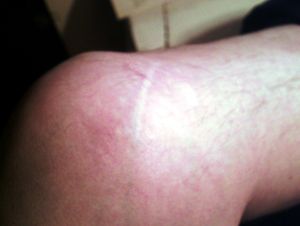 1980년 부분 좌측 반월판 절제술 흉터(사진 촬영 약 30년 전); 최근 수술은 더 작은 흉터를 남깁니다.