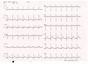다코츠보 심근증 환자의 심전도