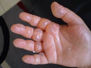 11세 소년의 심한 식물광선피부염 사례