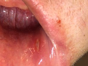 궤양은 다양한 모양과 크기를 가질 수 있다. 이 궤양은 길고 좁다.