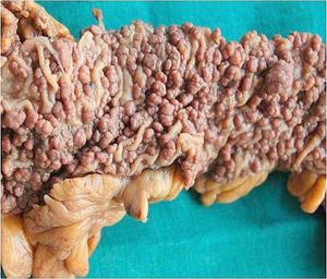 가족성 샘종 폴립증이 있는 사람의 결장 내에 대장 용종 다수가 있는 모습.