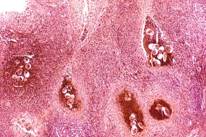 방광에 있는 빌하르츠 주혈흡충의 알.