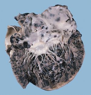 심장에 전이된 악성 흑색종