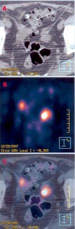 A – CT 영상; B – PET 영상; C – PET와 CT를 융합한 영상. 밝은 적/황색 덩어리는 69세 여성의 이전 수술로 제거된 결장암의 전이로 인한 골반(pelvis)의 과대사 부위를 보여준다.