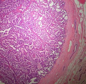 유두상 관내 상피내 암종(PDCIS)의 저배율 현미경 사진