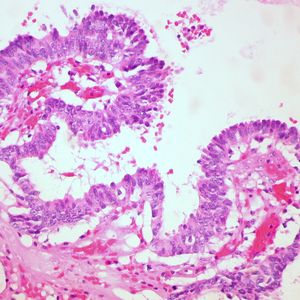 포낭 내 유두상 암종의 조직병리 소견