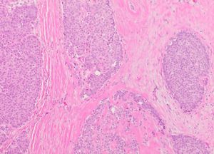 고형 유두상 암종의 조직병리학적 소견, H&E 염색. 종양 세포의 고형 시트(sheet)가 있는 큰 둥지(nest)와 다양한 양의 섬유혈관 코어(fibrovascular core)를 보여준다.
