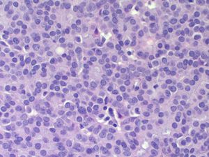 고형 유두상 암종(Solid Papillary Carcinoma)