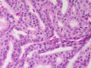 침윤성 유두상 암종