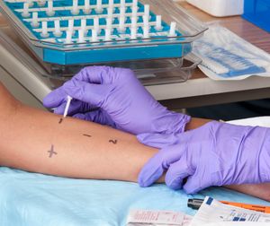 알레르기 피부 단자 검사. 양성 반응의 경우 피부가 붉게 변하고 부어오릅니다.