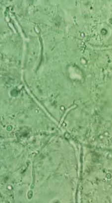 질 습윤 도말 검사에서 칸디다 질염이 나타난 모습으로, Candida albicans의 가짜 균사 슬링이 보인다. 후막 포자가 왼쪽에 보인다.