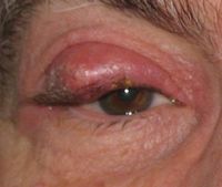 눈꺼풀에 큰 콩다래끼가 생긴 모습